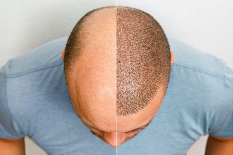 5 Reasons Why Hair Transplants Fail