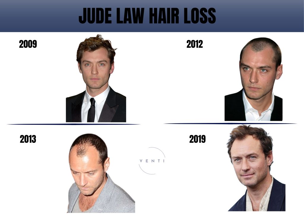 The Role of Stress and Lifestyle in Hair Loss