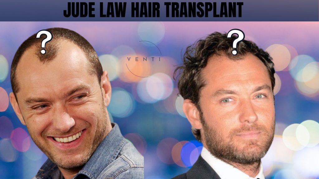 Did Jude Law Have A Hair Transplant?