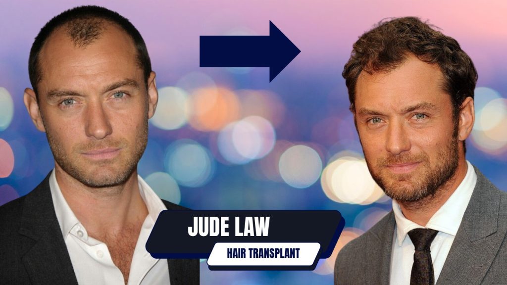 Jude Law Hair Transplant