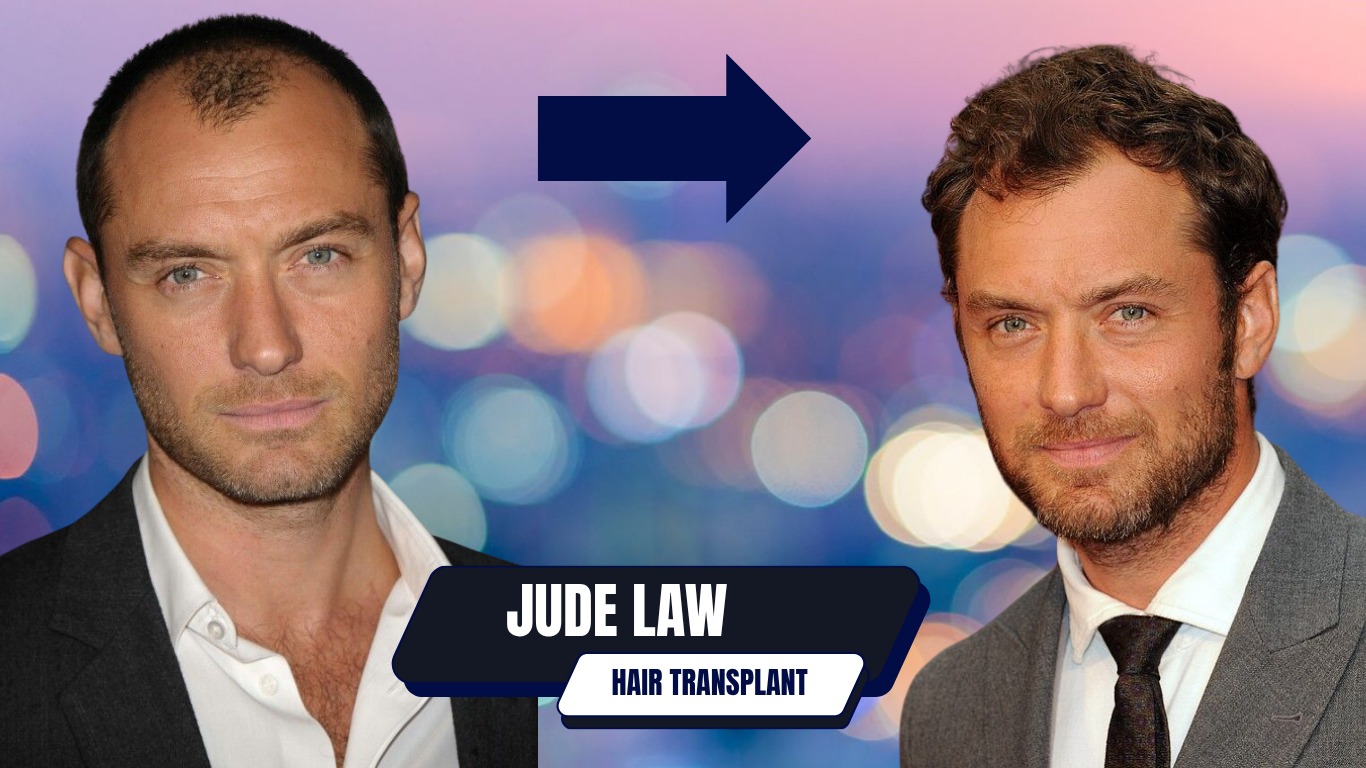 Jude Law Hair Transplant