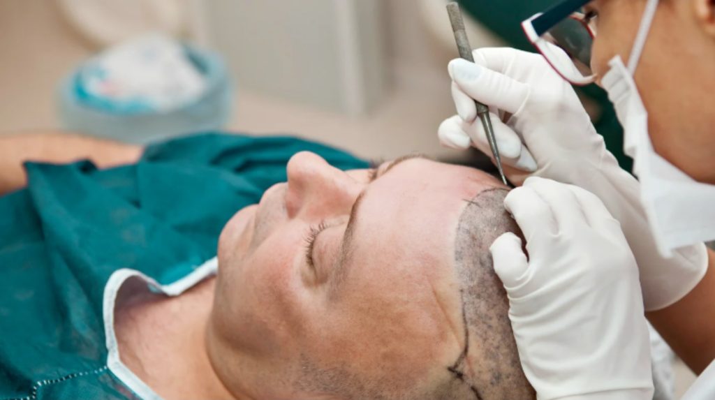 hair transplant procedure by doctor in turkey