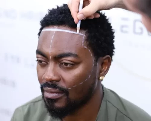 Afro Hair Transplant