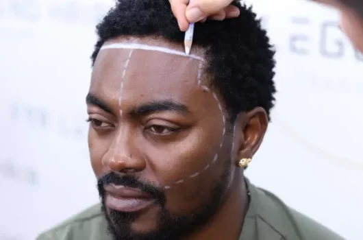 Afro Hair Transplant