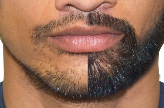 Beard and Mustache Transplant