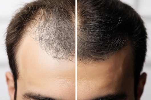 DHI Hair Transplant