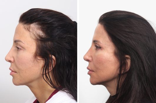 Female Hair Transplant
