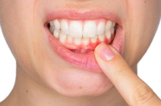 Gum Disease Treatment 4