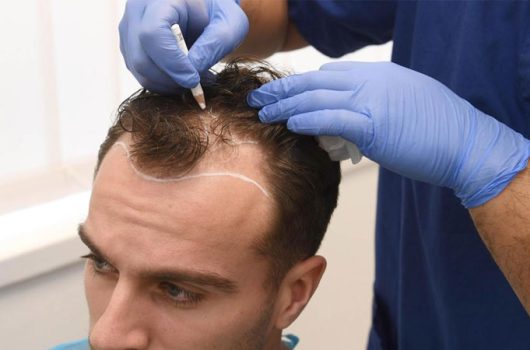 Stem Cell Hair Transplant