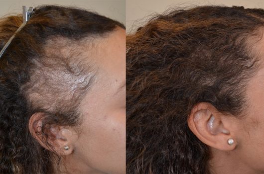 Traction-Alopecia-BA