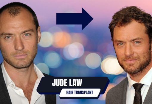 Jude Law Hair Transplant