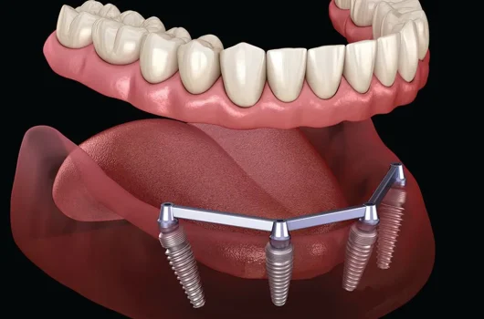 dental-implant-bar-overdenture